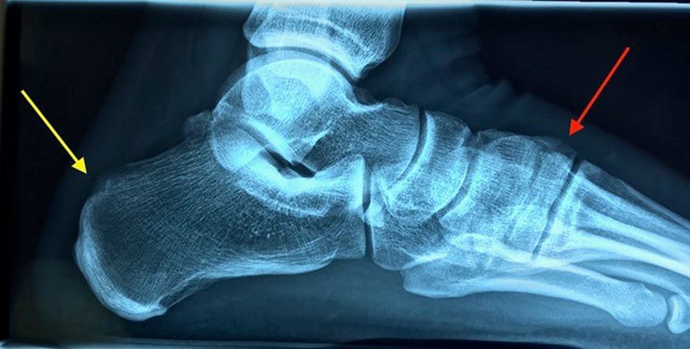 Dorsal foot growth - Dr. Michael Vitek | 1120 Vienna