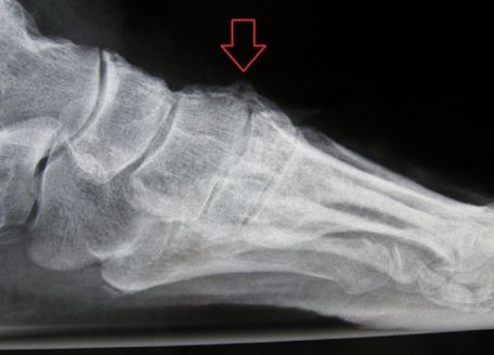 Dorsal foot growth - Dr. Michael Vitek | 1120 Vienna