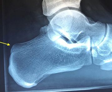 High heel bone - Dr. Michael Vitek | 1120 Vienna