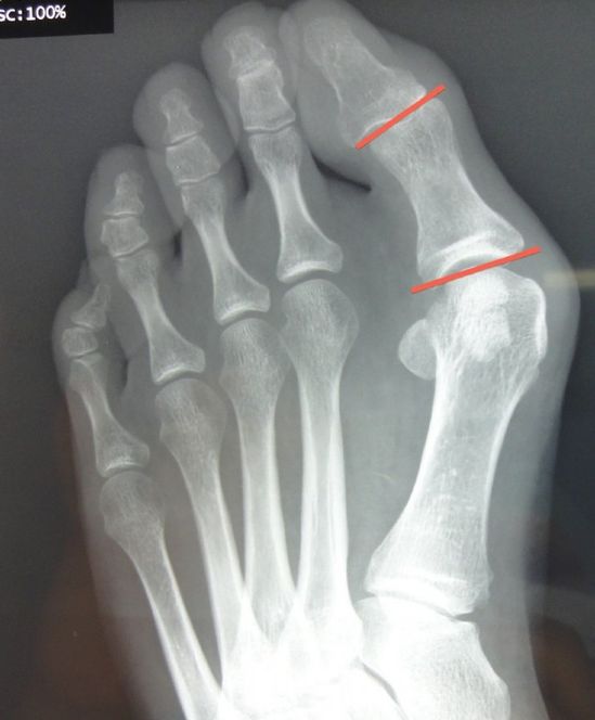 Interphalangeus Hallux Valgus Dr Michael Vitek